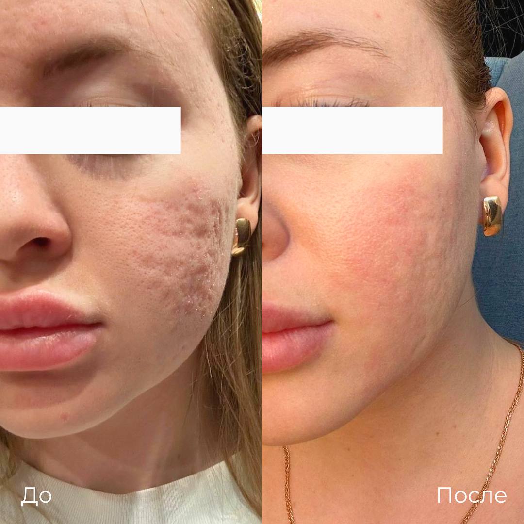 Субцизия фото 5