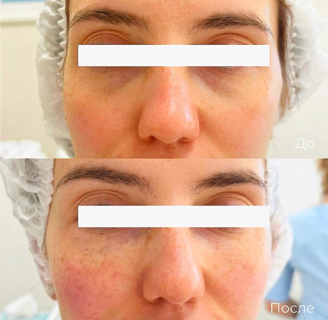 Коррекция темных кругов под глазами фото 7