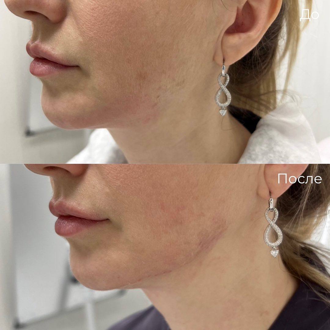 Мезонити фото 5