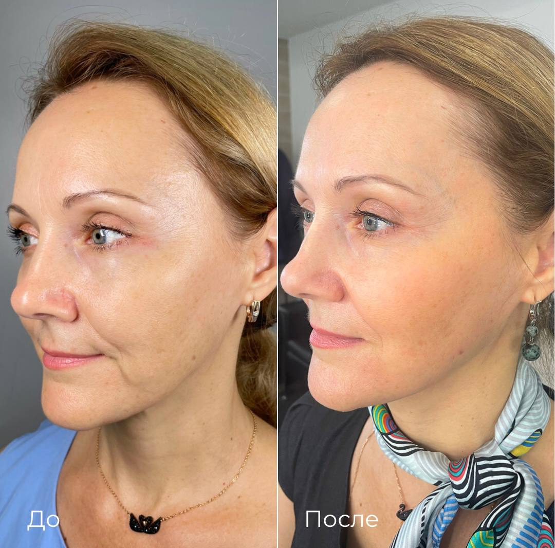 Лазерная шлифовка СО2 фото 6