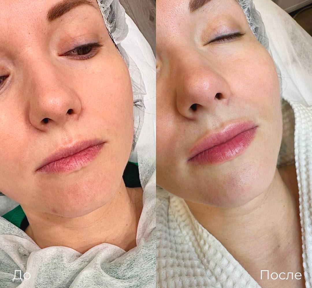 Увеличение и коррекция губ фото 38
