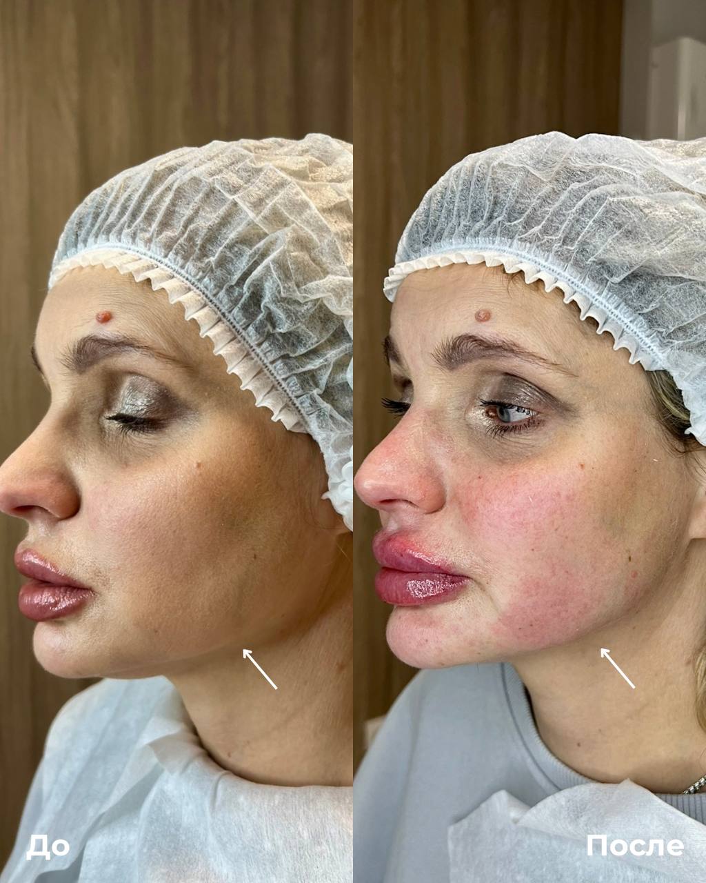 Контурная пластика лица фото 4