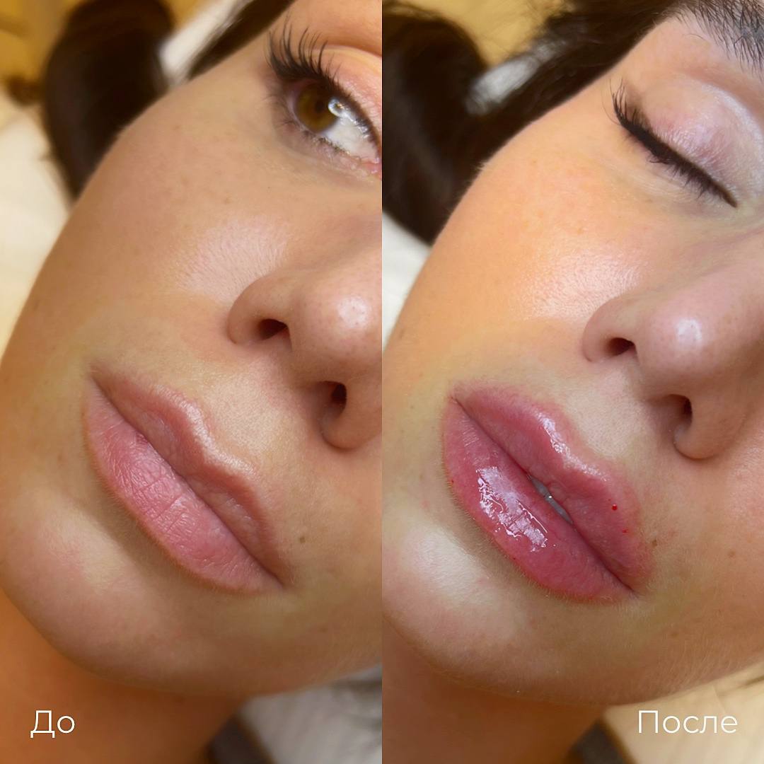 Увеличение и коррекция губ фото 1