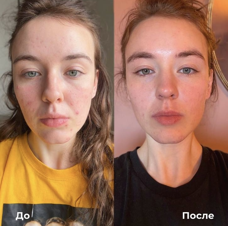 Лазерное лечение акне фото 2