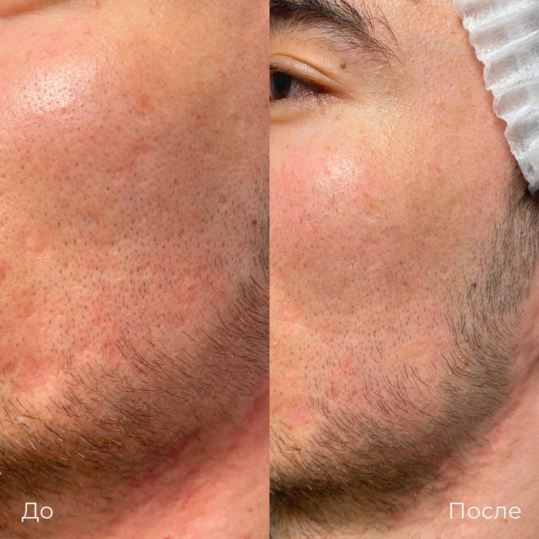 Субцизия фото 4