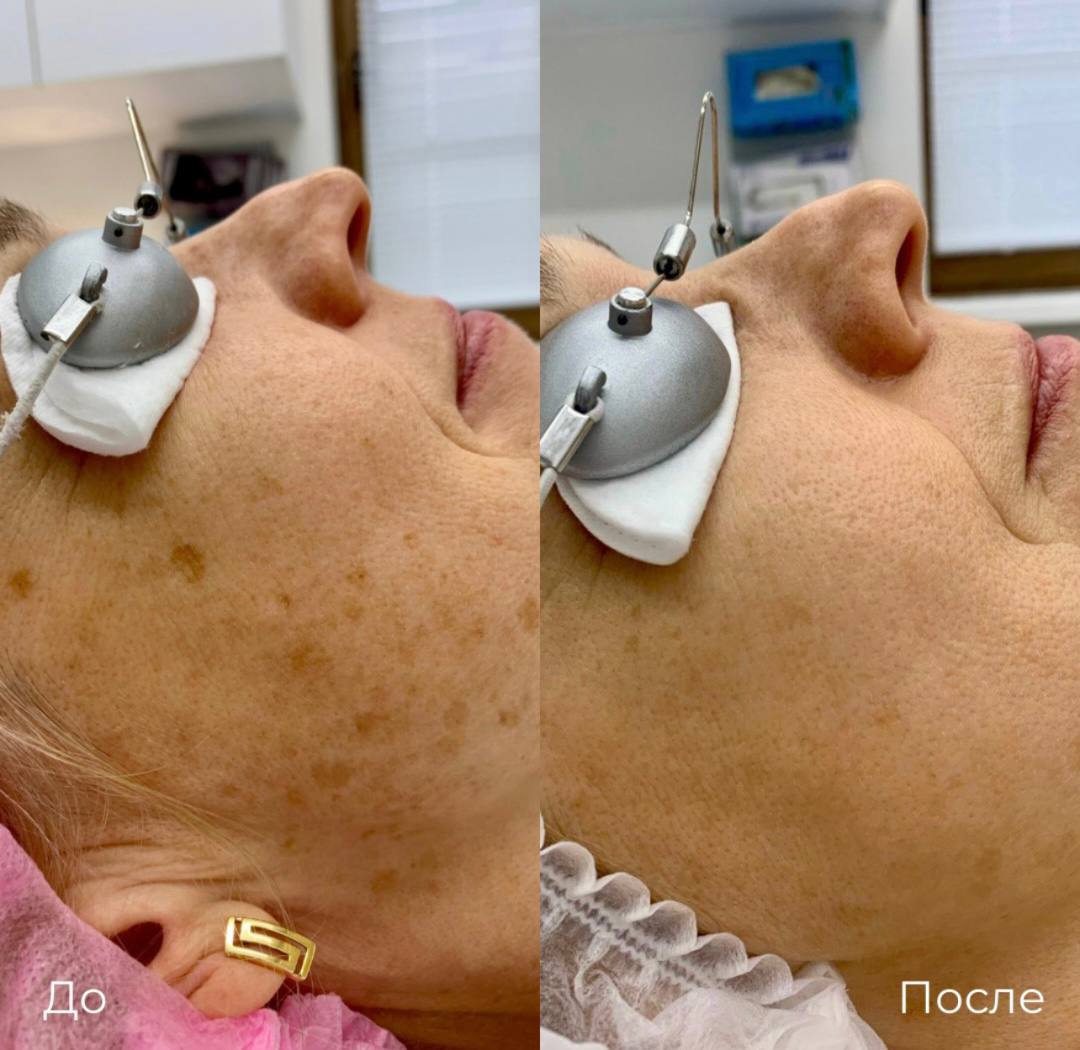 Фототерапия от пигментных пятен фото 4