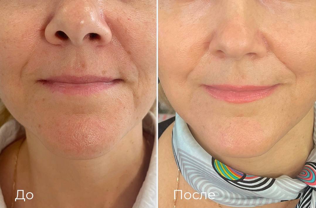 Лазерная шлифовка СО2 фото 1