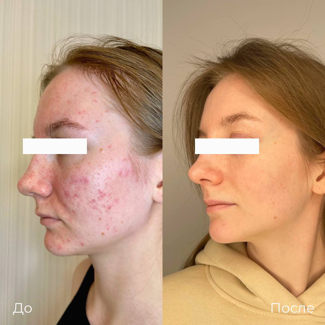 Лазерное лечение акне фото 6