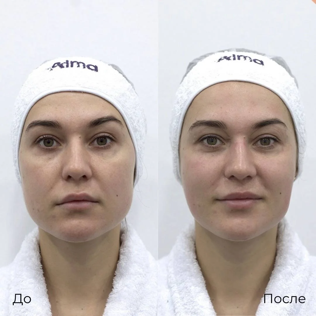 Фотоомоложение фото 2