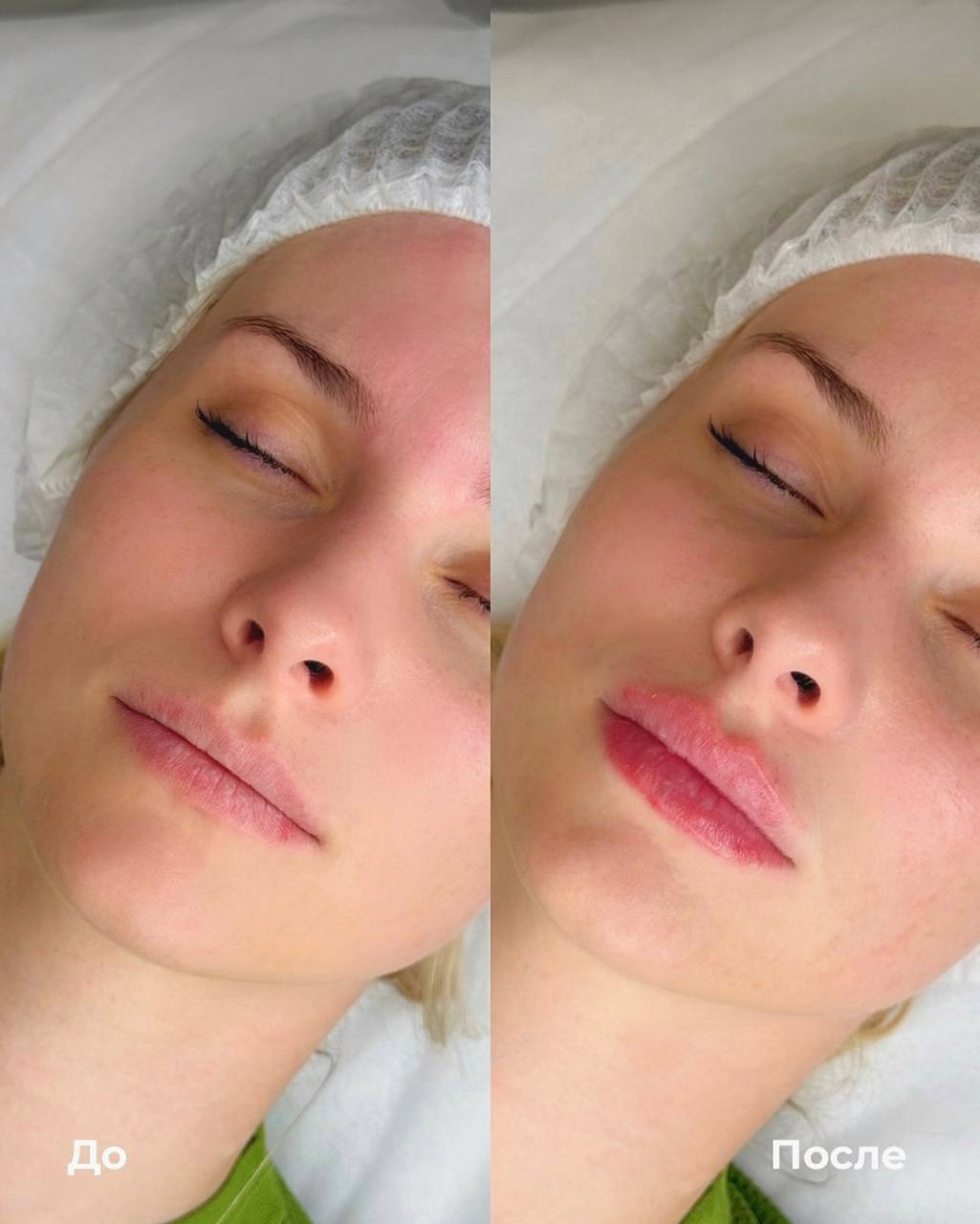Увеличение и коррекция губ фото 2