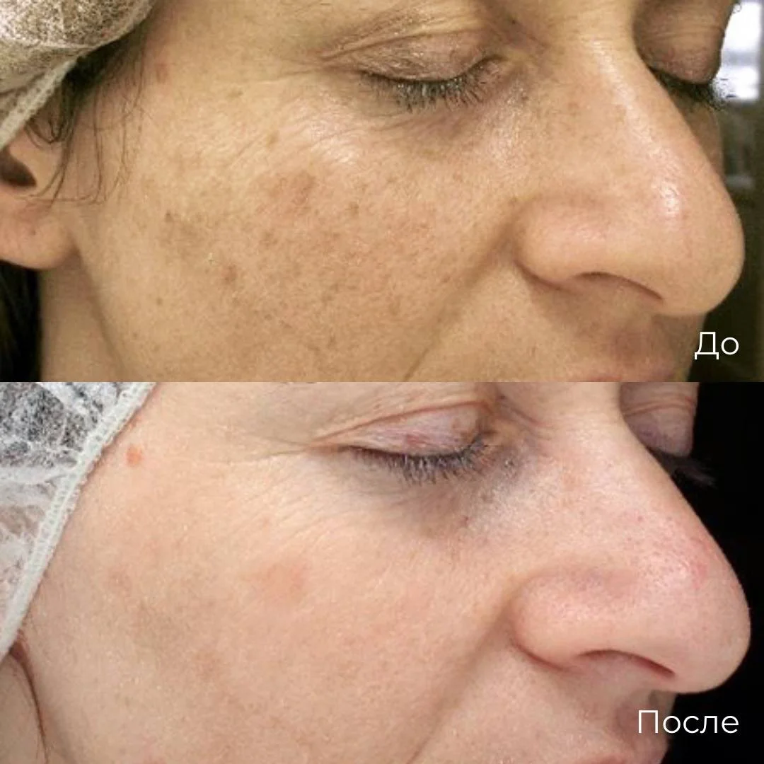 Фотоомоложение фото 4