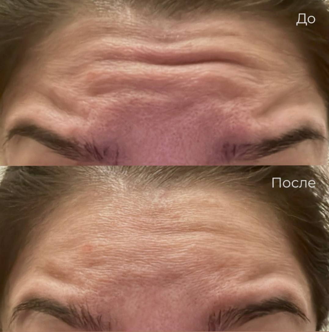 Коррекция мимических морщин фото 3
