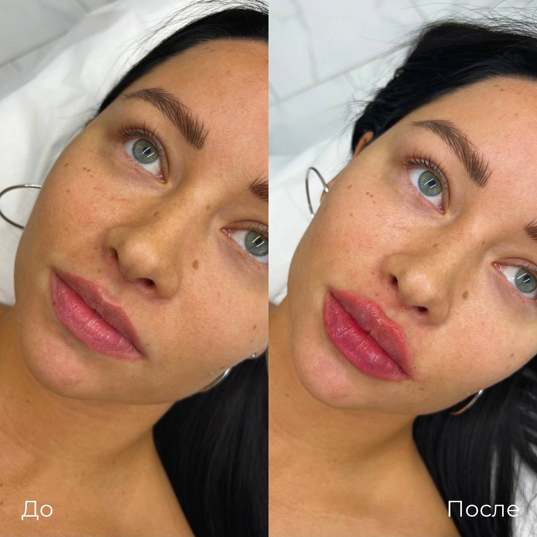 Увеличение и коррекция губ фото 14