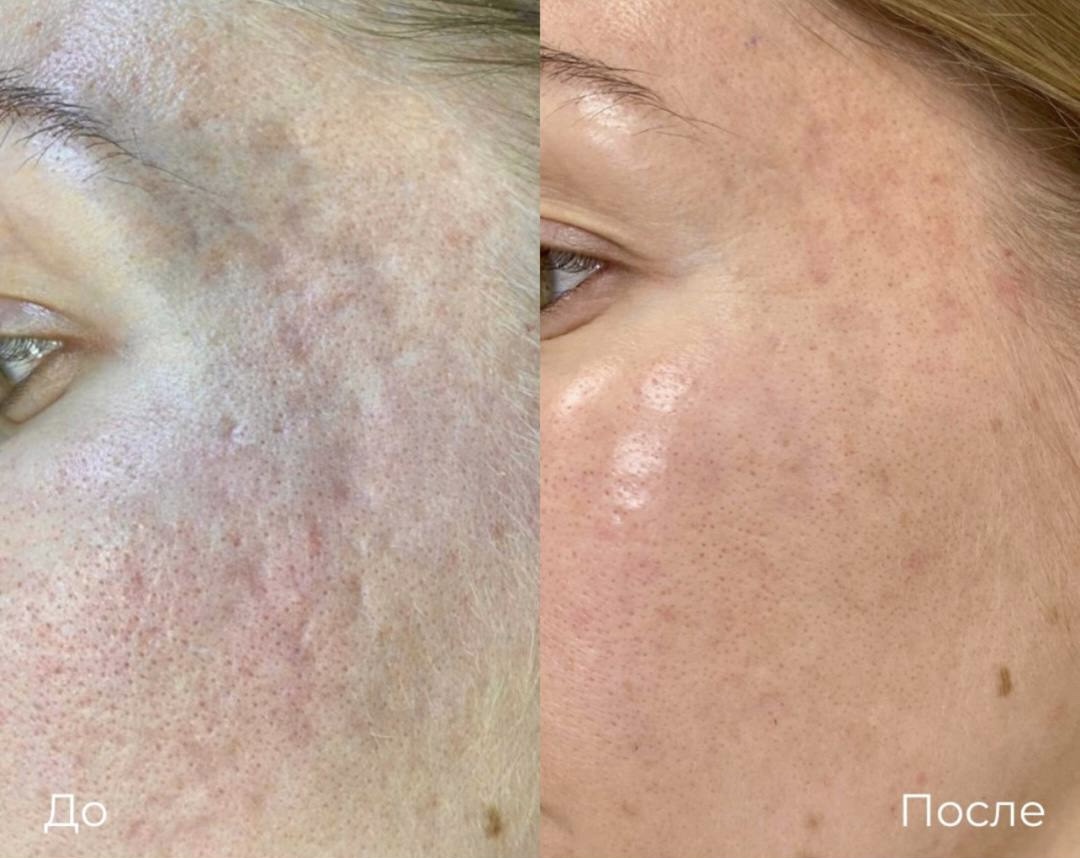 Субцизия фото 9