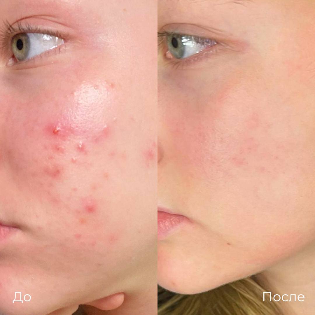 Лазерное лечение акне фото 11