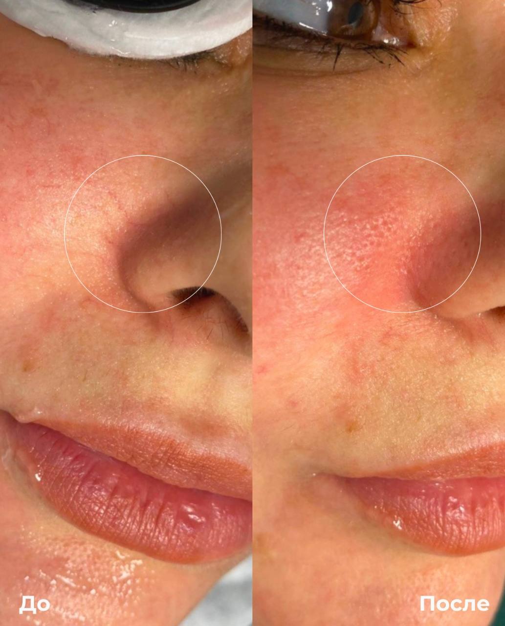 Фототерапия купероза фото 8