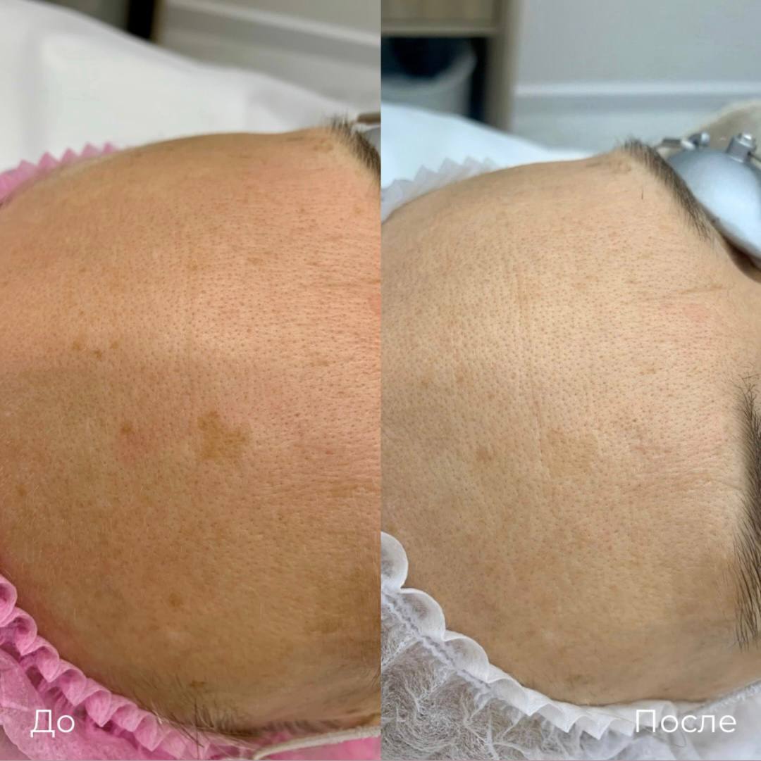 Фототерапия от пигментных пятен фото 5