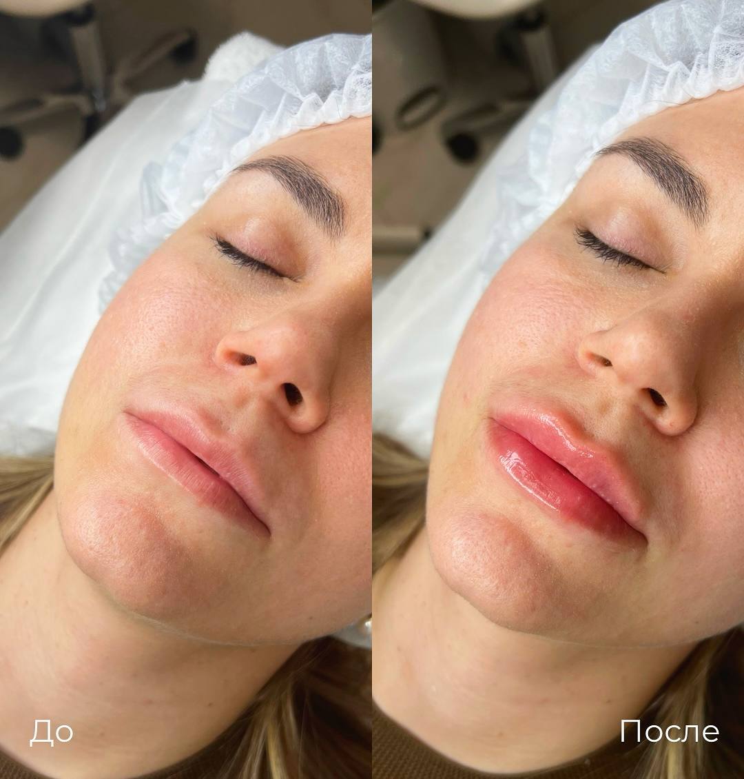 Увеличение и коррекция губ фото 36