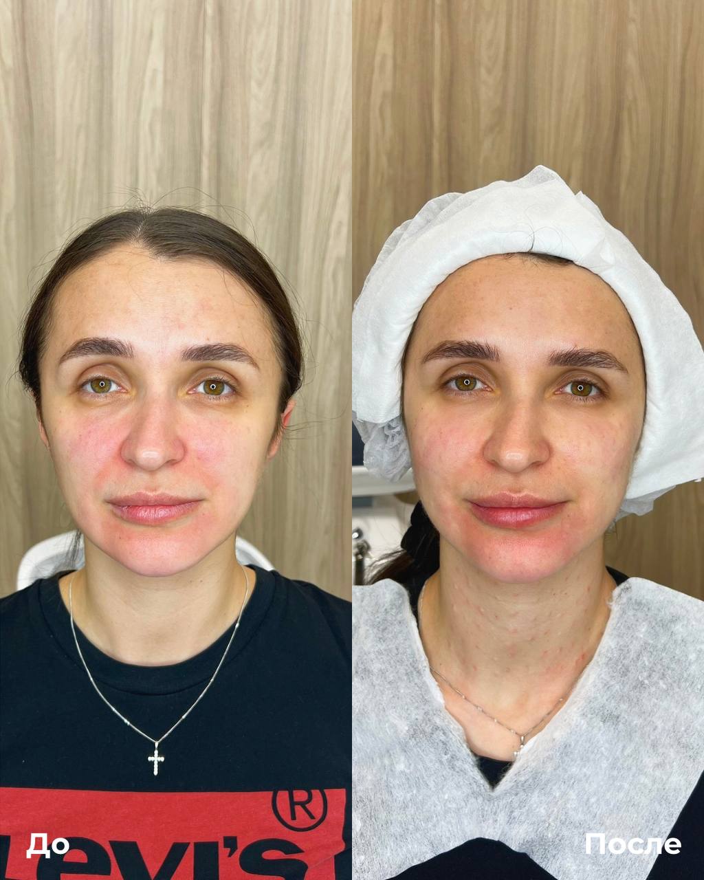 Биоревитализация фото 3