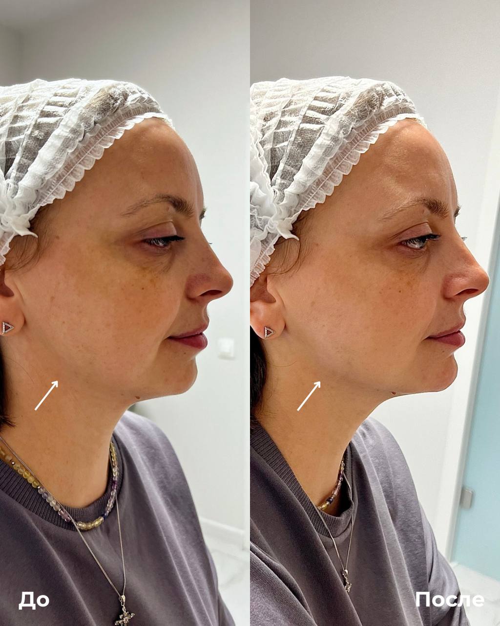 Контурная пластика лица фото 3