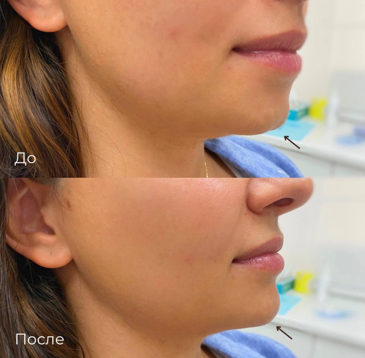Контурная пластика лица фото 10