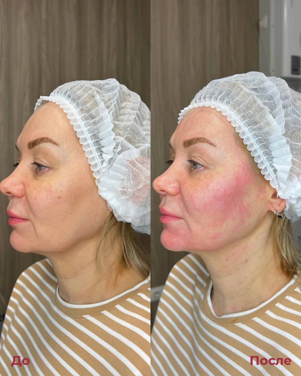 Биоревитализация фото 5