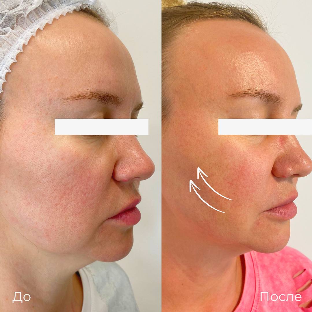 SMAS лифтинг лица Ultraformer фото 9