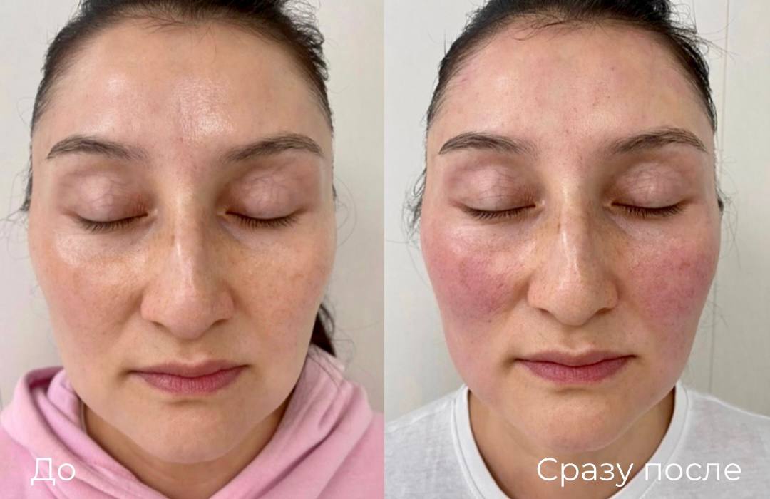 Нитевой лифтинг Aptos фото 2