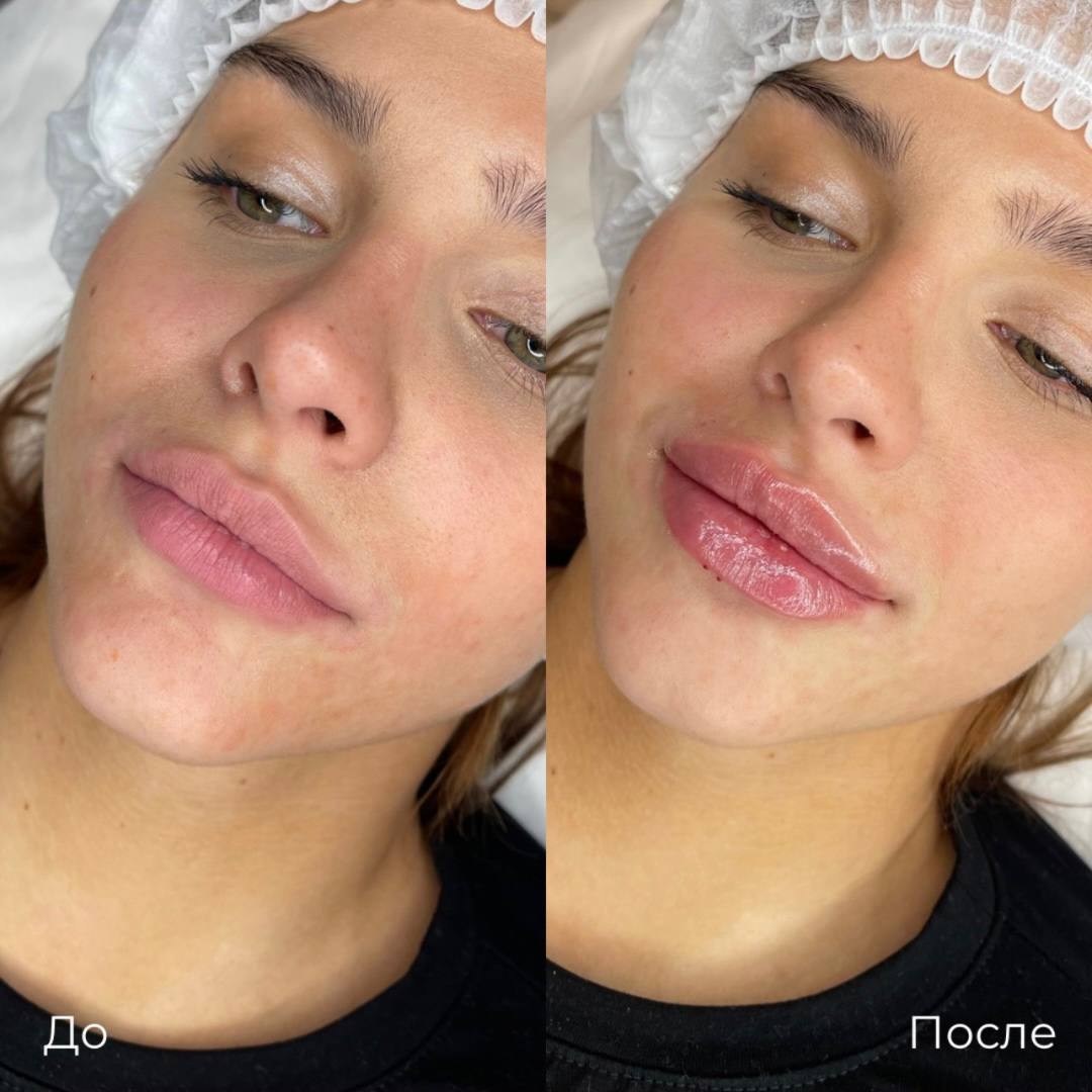 Увеличение и коррекция губ фото 19