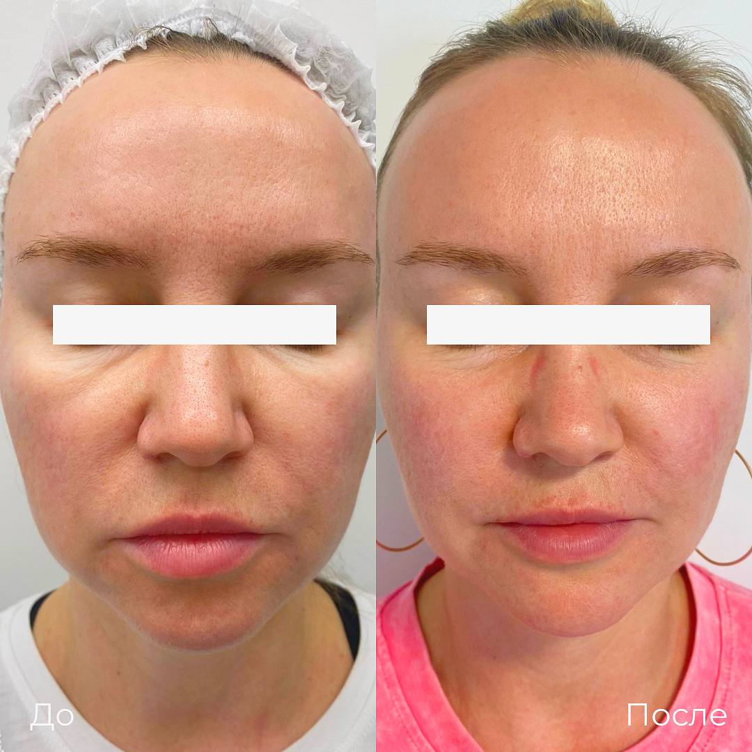 SMAS лифтинг лица Ultraformer фото 11