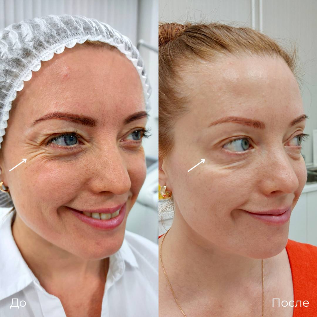 Коррекция мимических морщин фото 4