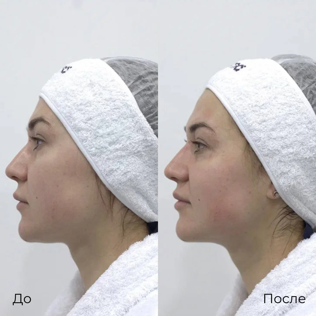 Фотоомоложение фото 3