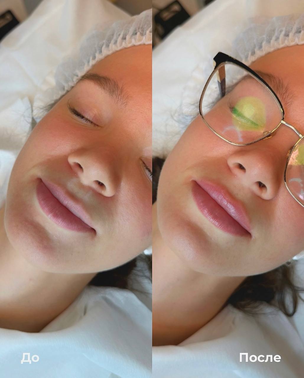 Увеличение и коррекция губ фото 3