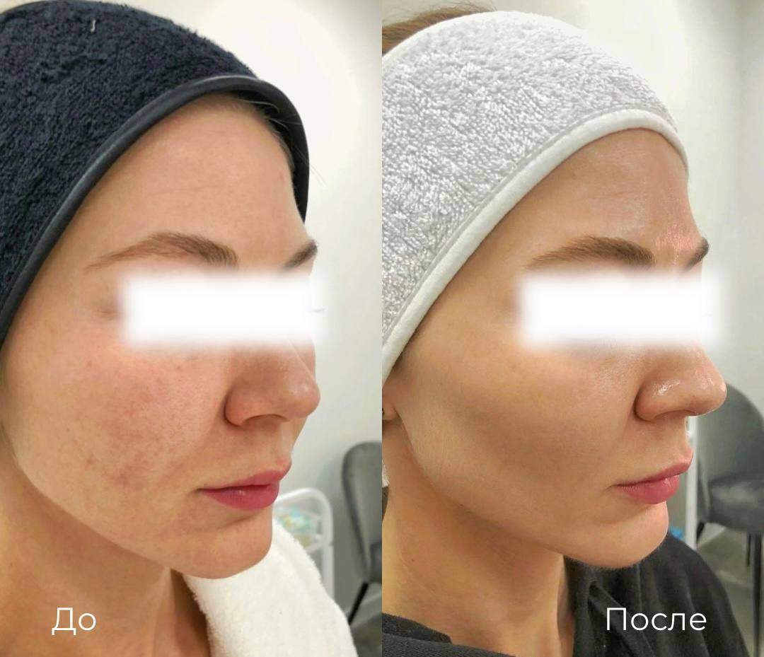 Фототерапия от пигментных пятен фото 1