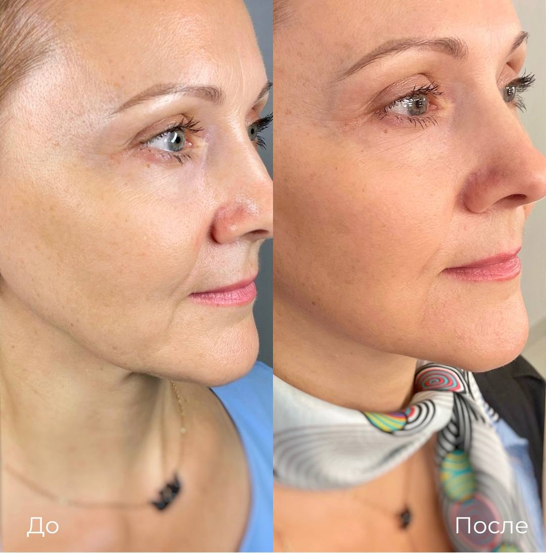 Лазерная шлифовка СО2 фото 4