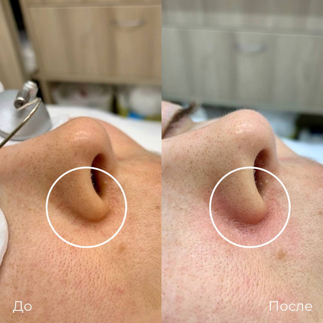 Фототерапия купероза фото 11