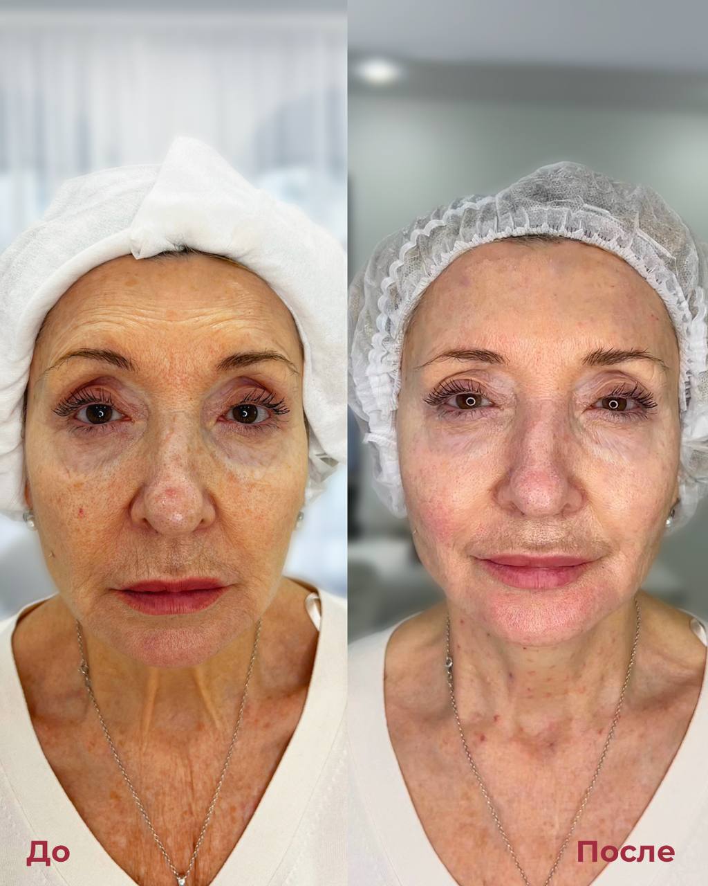 Биоревитализация фото 6