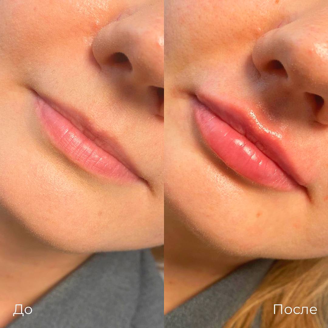 Увеличение и коррекция губ фото 30