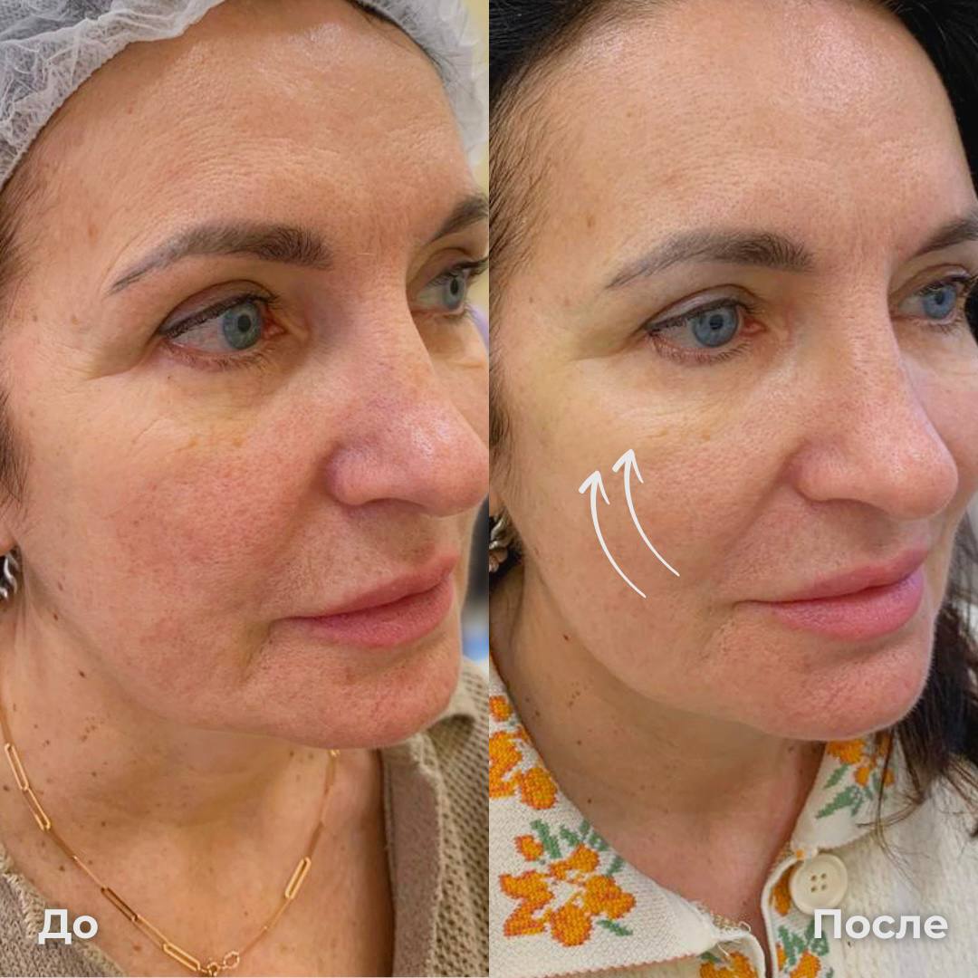 SMAS лифтинг лица Ultraformer фото 4