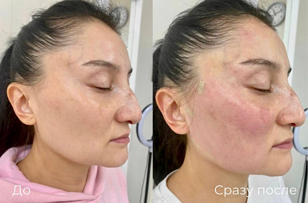 Нитевой лифтинг Aptos фото 1