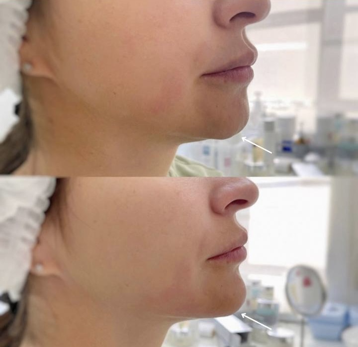 Контурная пластика лица фото 6