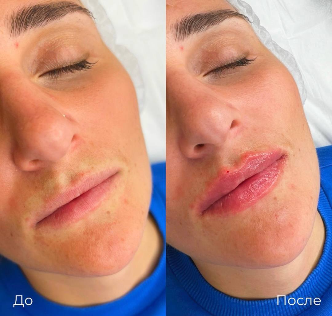Увеличение и коррекция губ фото 35