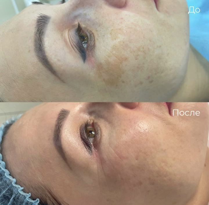 Биоревитализация фото 1