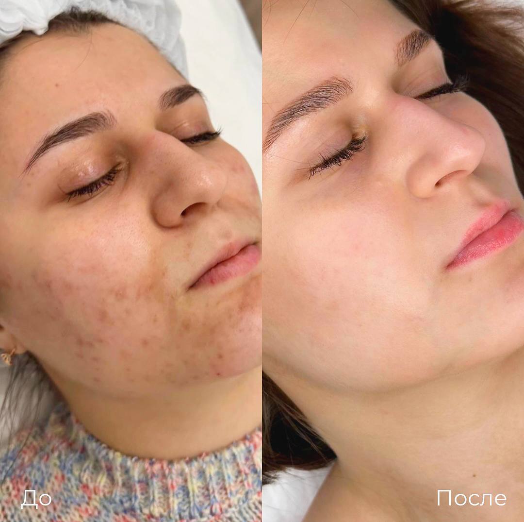 Увеличение и коррекция губ фото 25