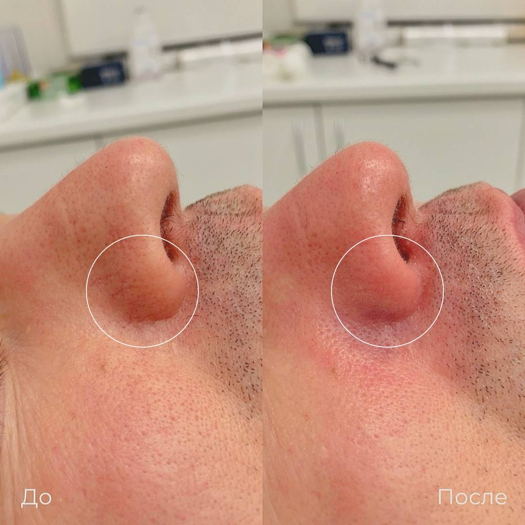 Фототерапия купероза фото 1