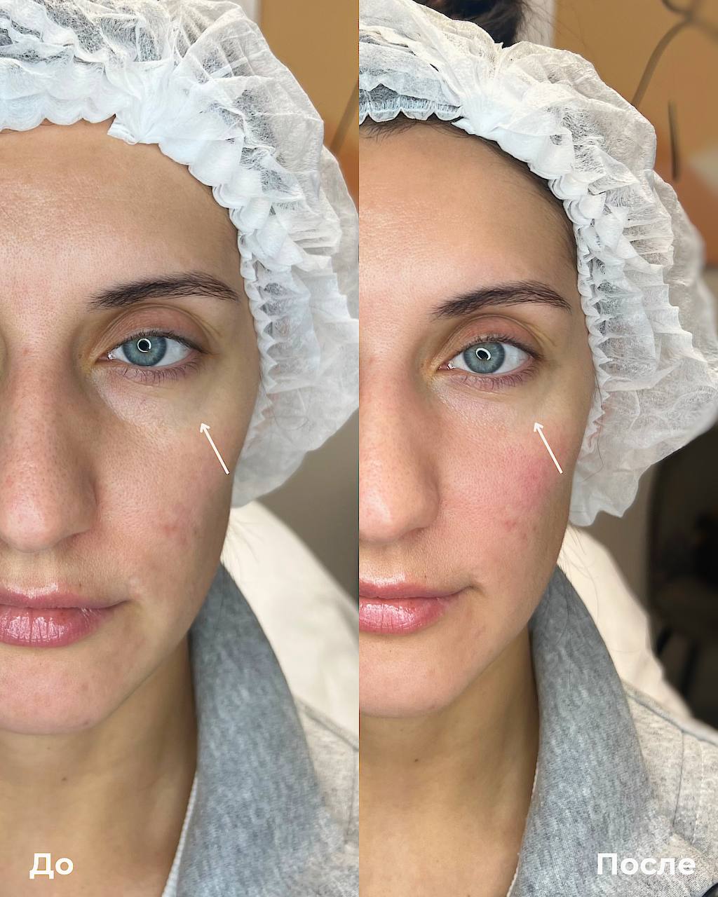 Коррекция темных кругов под глазами фото 3