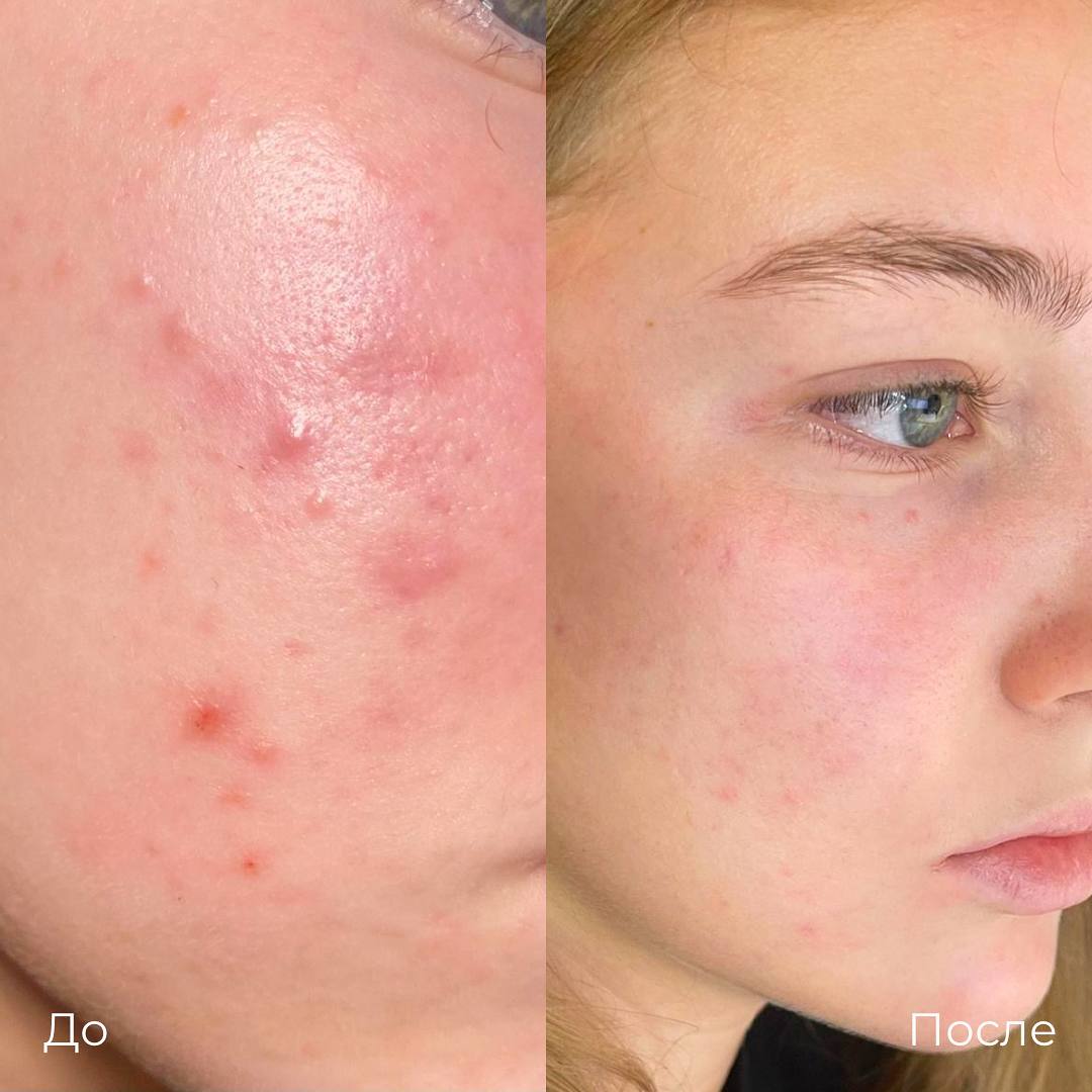 Лазерное лечение акне фото 10