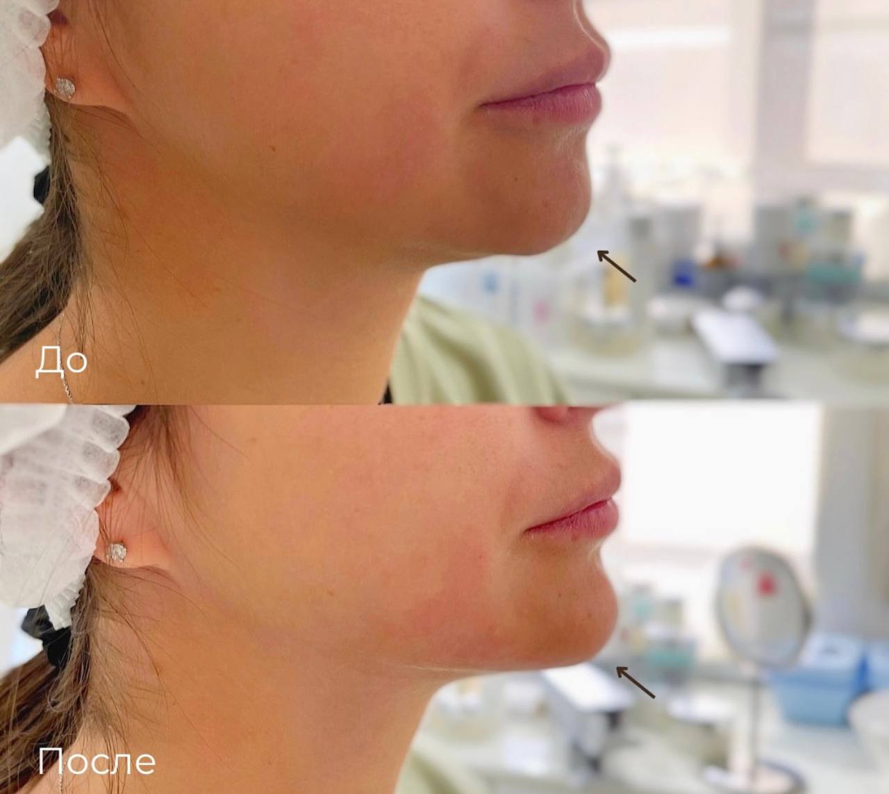 Контурная пластика лица фото 11