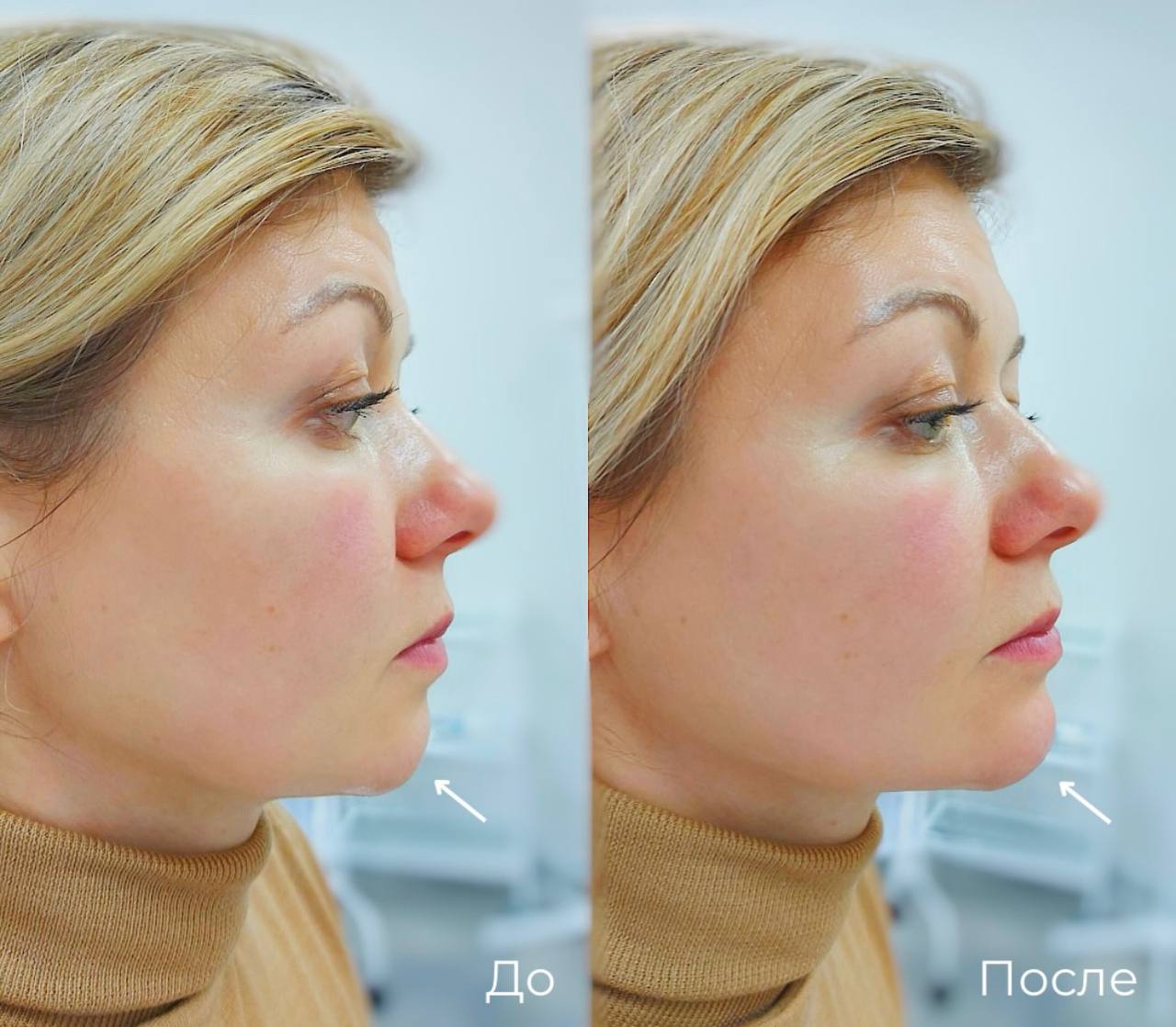 Контурная пластика лица фото 9