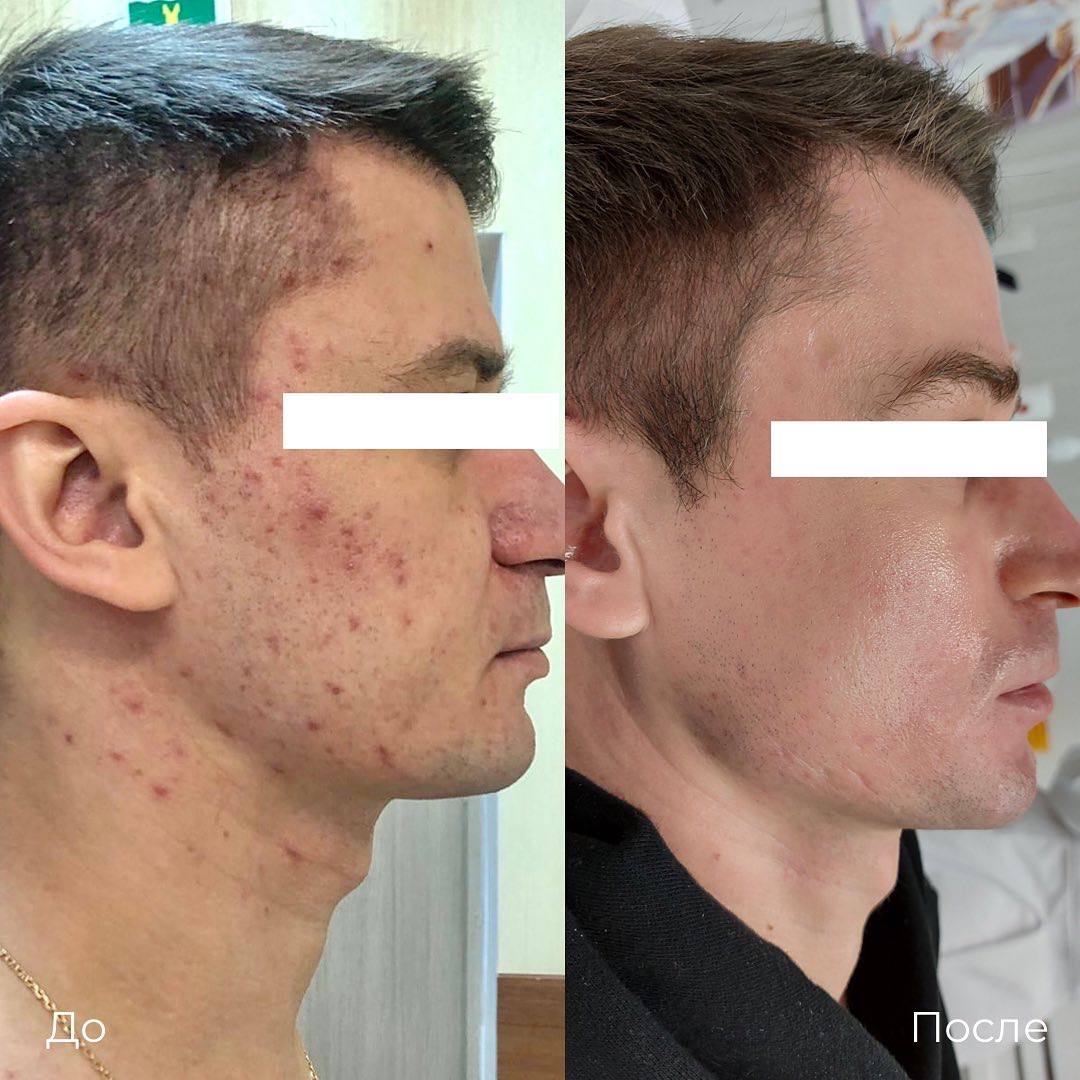 Лазерное лечение акне фото 1